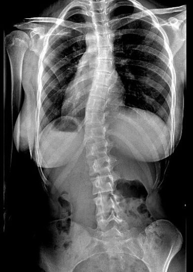 Radiografie Scolioză- Radiografie Scolioză-