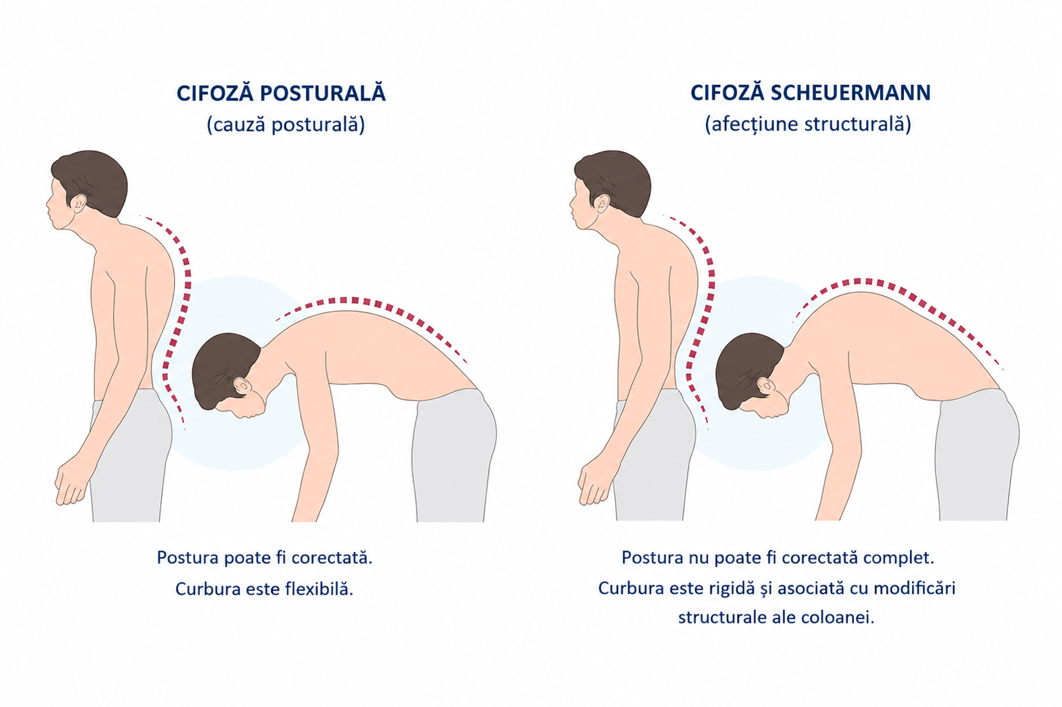 Cifoza posturala vs. Maladia Schuermann