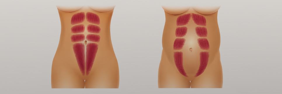Diastază Abdominală
