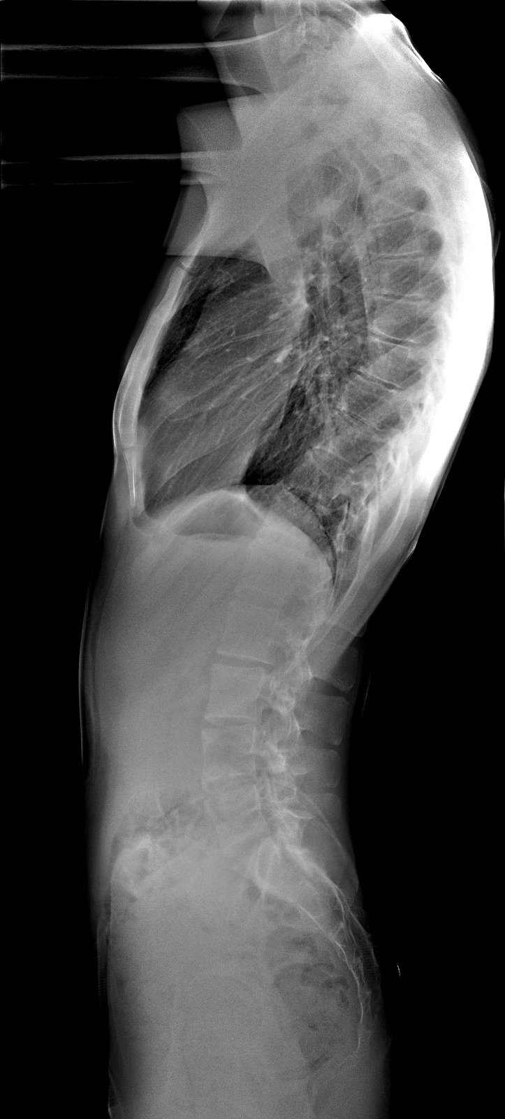 Radiografie Cifoză Schuermann