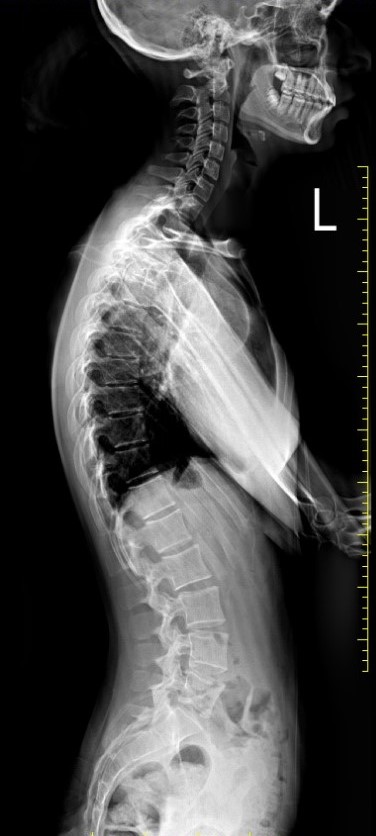 Radiografie Hipercifoză