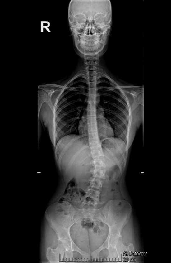 Radiografie Scolioză