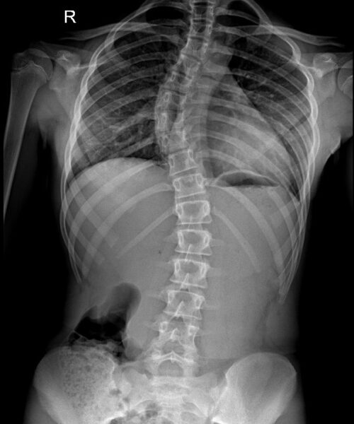 Radiografie Scolioză. Radiografie Scolioză.
