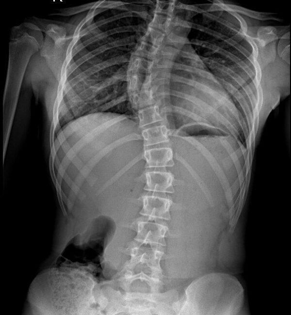 Radiografie Scolioză.