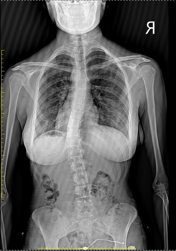 Radiografie Scolioză,
