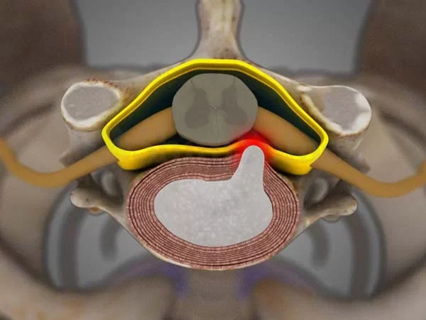 0019_CERVICAL-DISC-HERNIATION-1 0019_CERVICAL-DISC-HERNIATION-1