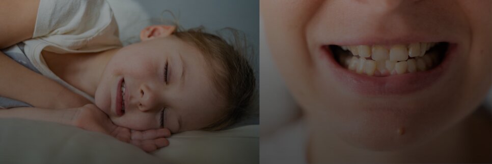 Bruxism