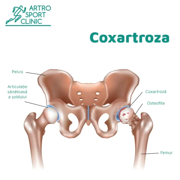 Coxartroza-v1