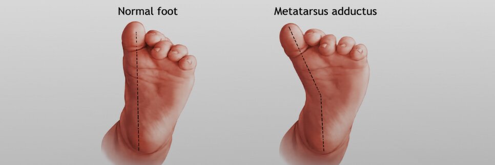 Metatarsus Adductus