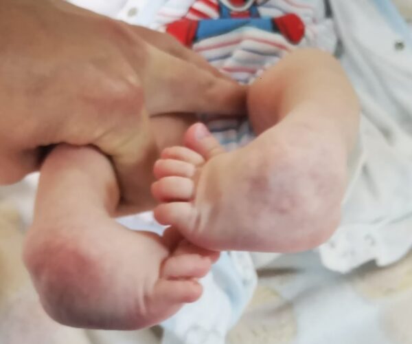 Piciorul-stramb-congenital-Piciorul-varus-equin-PVE-1