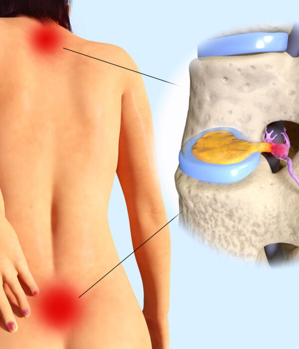 Spinal-disc-herniation.-Illustration-Depositphotos_250921628_L