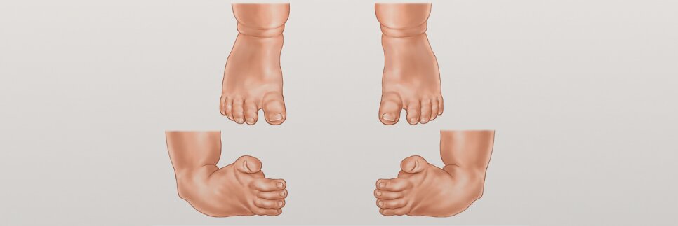 Varus equin (picior strâmb congenital / talipes equinovarus)