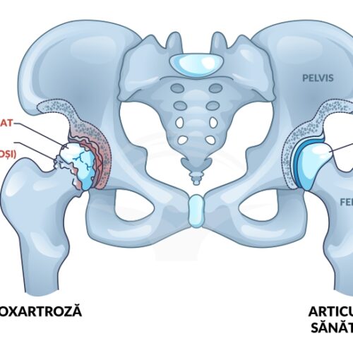 coxartroza-diagnostic