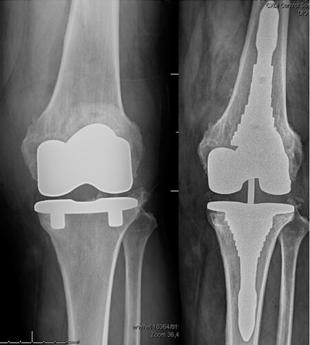 recambio-de-protesis-de-rodilla